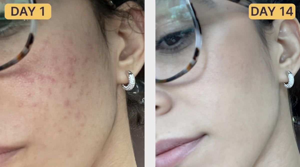 Breakouts Cleared Up Without Drying Me Out
